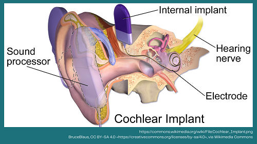 A diagram of the inner ear and showing the cochlear implant with the electrode going to the cochlea.